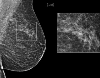 RSNA AI Challenge Models Interprets Mammography Screening