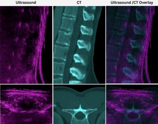 Real-Time Panoramic Ultrasound Approach Expands Spine Imaging Options