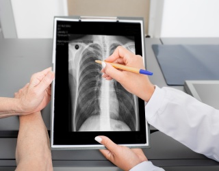 AI Chest X-Ray Analysis Helps Detect Hidden Lung Cancer Risks