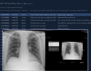 AI Tool Accelerates Lung Cancer Detection Across North East London