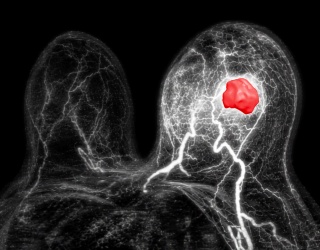 Quibim brings AI-powered breast MRI cancer detection to Europe