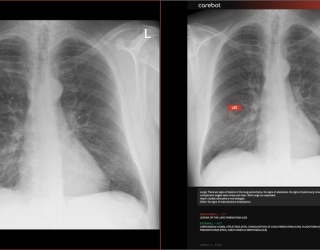 Photo: Carebot and Bristol-Myers Squibb join forces to fight lung cancer with...