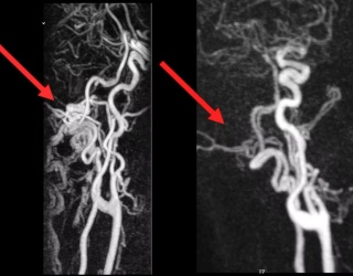 Photo: Neuroradiology Enables Targeted Treatment for Pulse-Synchronous Tinnitus...